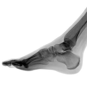 X-ray picture of the human foot